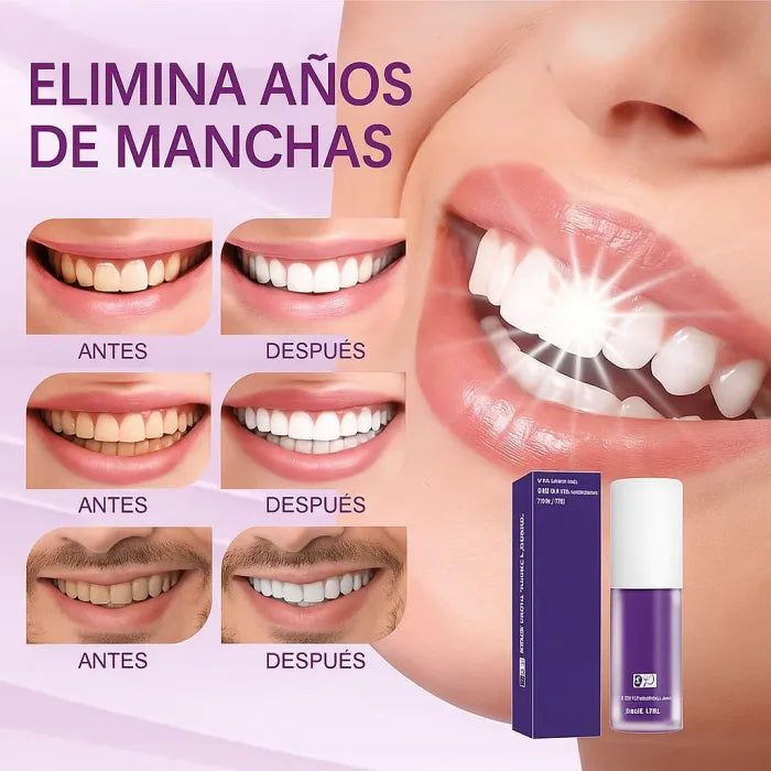 GlorySmile™ - Blanqueador Dental V34